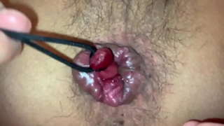 内痔核を縛り上げて引き回す 内痔核を縛り上げて引き回す